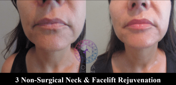 Natural Face Lift - Image 3